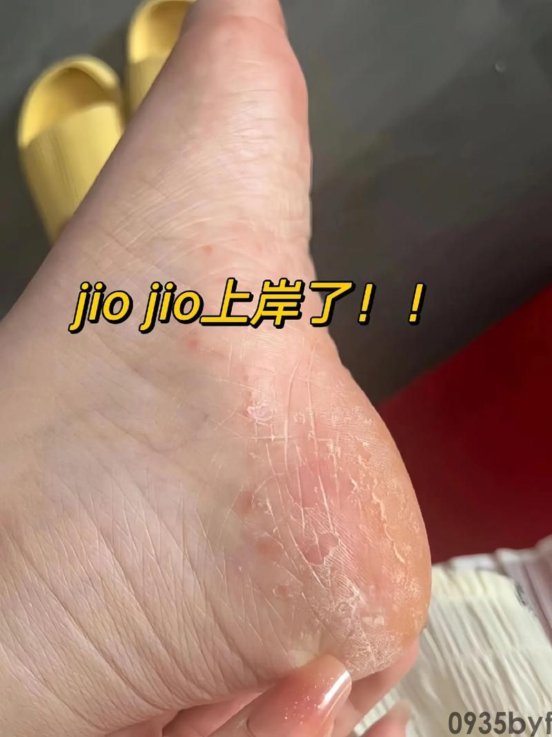 瘙痒型脚气,医学上称为“足癣”或“脚癣”,是一种由真菌感染引起的常见皮肤病(图2) u=4102353941,2996829718&fm=253&app=138&f=JPEG.jpg