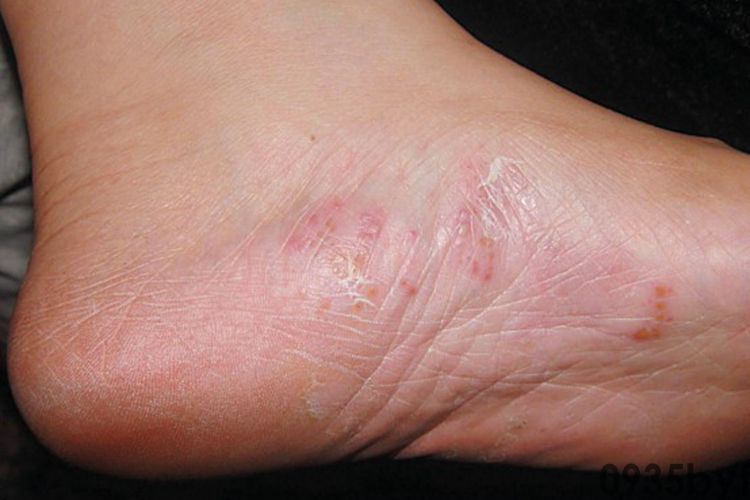 水疱型脚气,医学上称为"水疱型足癣",是真菌感染足部皮肤后引起的一种特殊临床表现类型(图1) 00DB783B212947F22917C50991E087AE.jpg