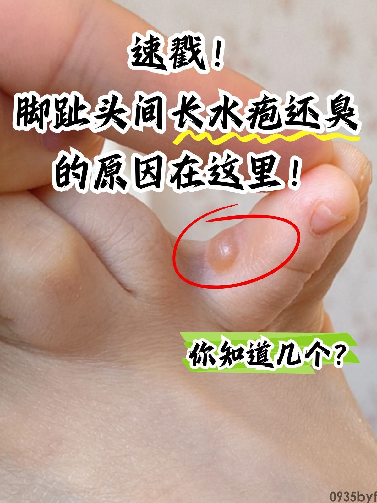 水疱型脚气,医学上称为"水疱型足癣",是真菌感染足部皮肤后引起的一种特殊临床表现类型(图4) 5f997525e6b2bc5415d13e269943f5a1.jpeg