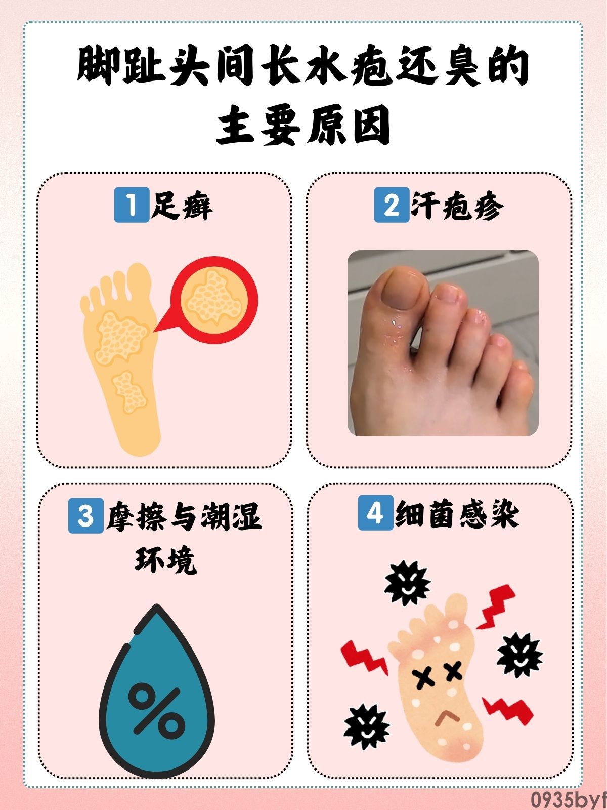 水疱型脚气,医学上称为"水疱型足癣",是真菌感染足部皮肤后引起的一种特殊临床表现类型(图5) 9f7cc28ccbae5633e6b1b70a0158c635.jpeg