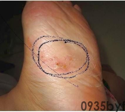 水疱型脚气,医学上称为"水疱型足癣",是真菌感染足部皮肤后引起的一种特殊临床表现类型(图6) 2172810.jpg