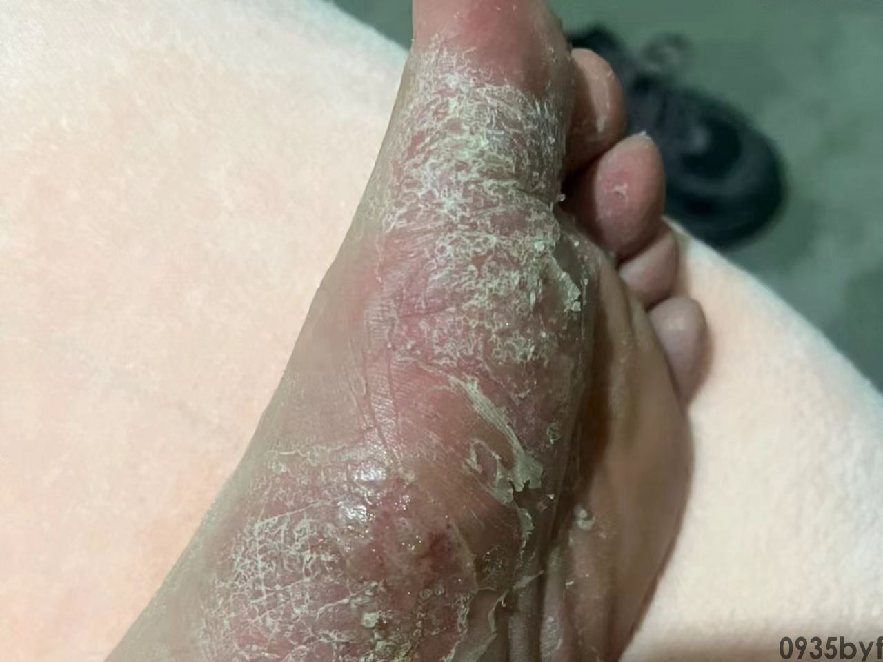 异味型脚气,医学上称为"臭汗症型足癣",是足部真菌感染中极具特征性的一种特殊临床类型(图1) 6413b46cb598e928cf29decbb944bc4005628f4c.jpg