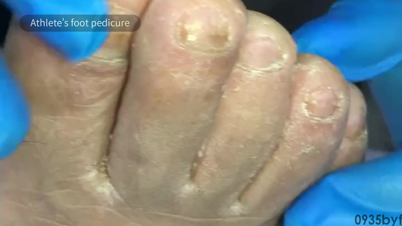 异味型脚气,医学上称为"臭汗症型足癣",是足部真菌感染中极具特征性的一种特殊临床类型(图2) a23c2e1f71b810552e7b0288361659e281ff15d4.jpg