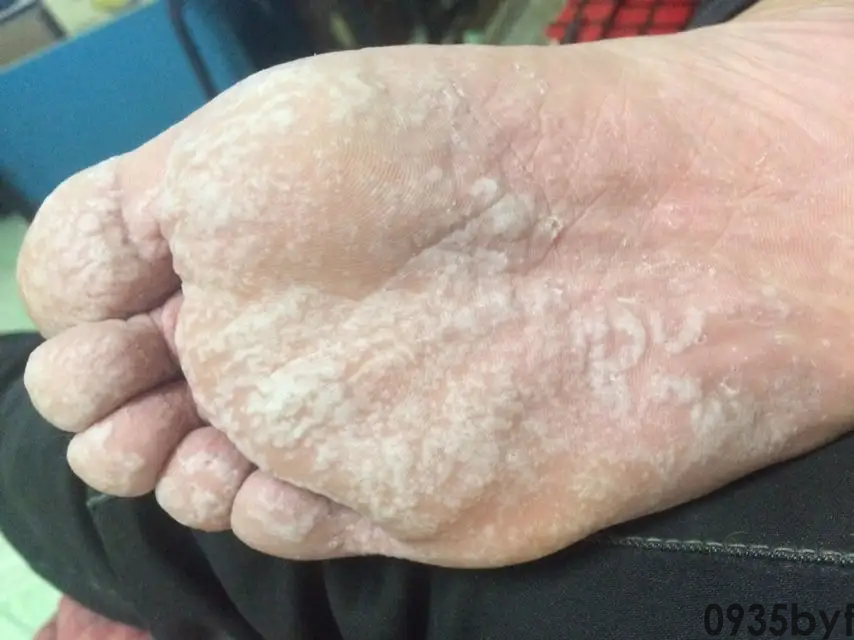 异味型脚气,医学上称为"臭汗症型足癣",是足部真菌感染中极具特征性的一种特殊临床类型(图4) F78915948A386CF7CB2A5496F17D4FF3.png
