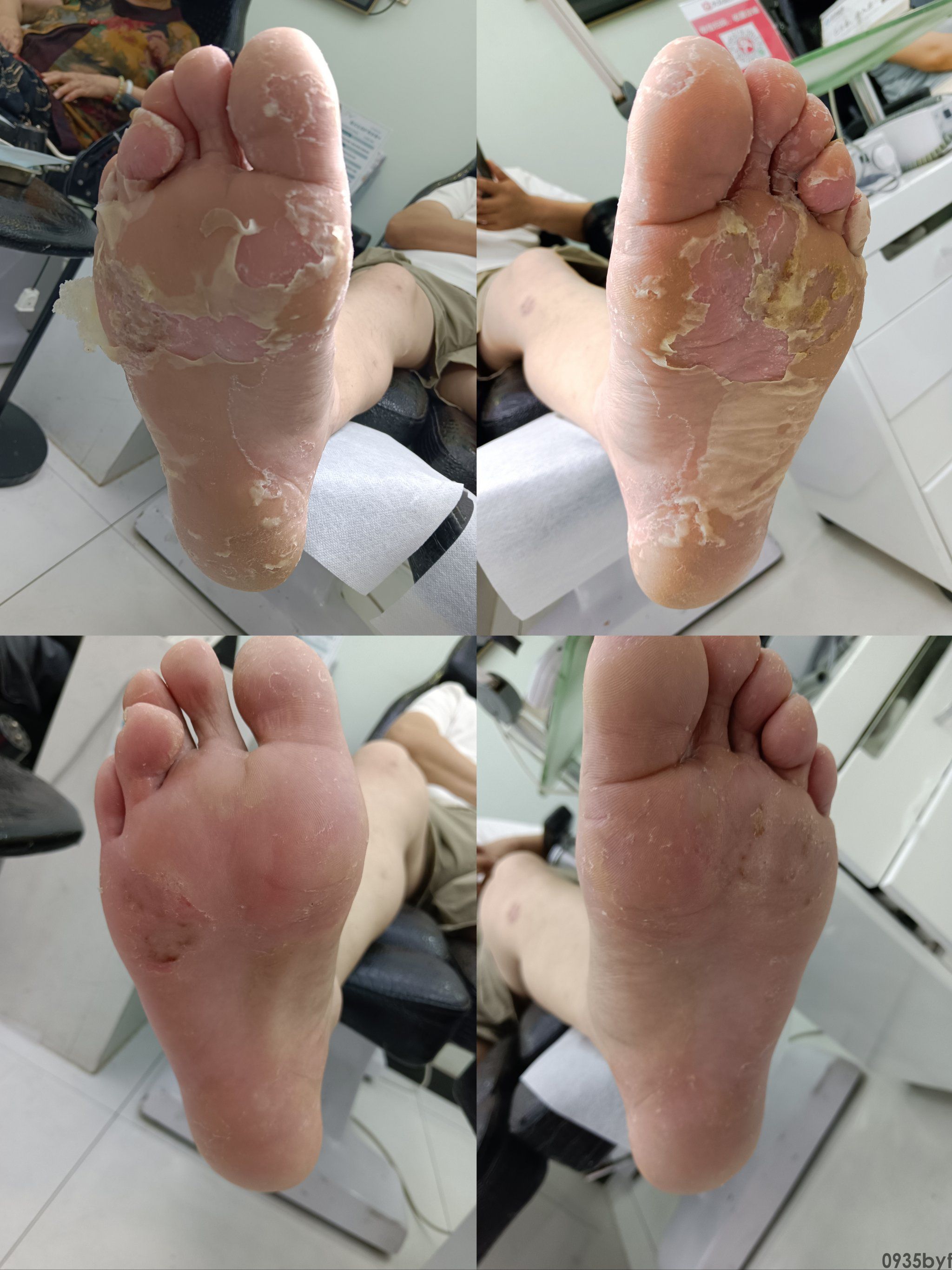 异味型脚气,医学上称为"臭汗症型足癣",是足部真菌感染中极具特征性的一种特殊临床类型(图5) mowjUqaH0mWZ-pDlbLgHnbydCIGFT67Q5bq5qP3iNoB4gxtGZg6XJdggxf0qvmtL.jpg