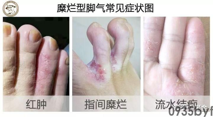 糜烂型足癣脚趾缝痒溃烂流水图-有来医生(图1) 糜烂型足癣脚趾缝痒溃烂流水图-有来医生