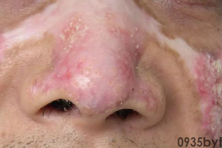 皮肤红斑图片与病症