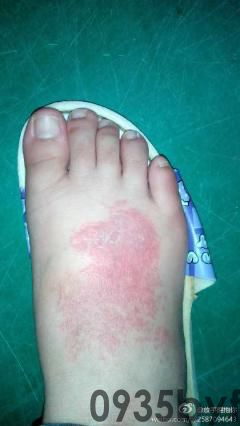 脚上起红斑不痛不痒(图1) 脚上起红斑不痛不痒