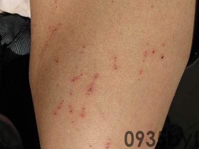 身上皮肤瘙痒症状图片(图1) 身上皮肤瘙痒症状图片(图1)