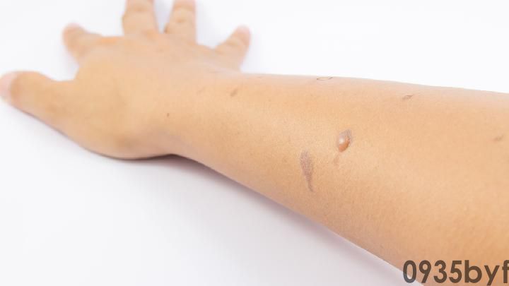 湿疹红斑怎么消除