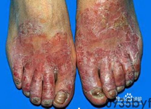 鳞屑角化型足癣脚底增厚发黄图-有来医生