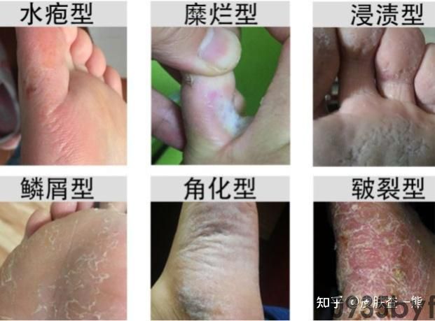 糜烂型脚气怎么根治