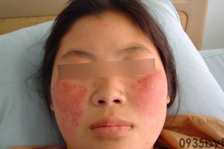 红斑狼疮患者注意事项