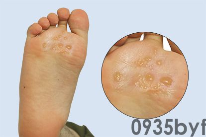 水疱型脚气图片(图1)