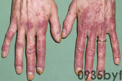 系统性红斑狼疮早期症状图片(图2)