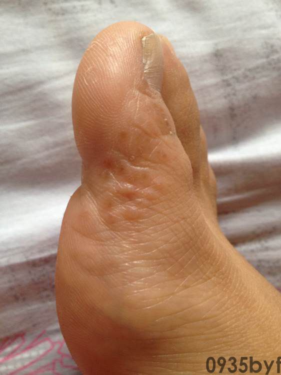 水疱型汗疱疹脚气的区别