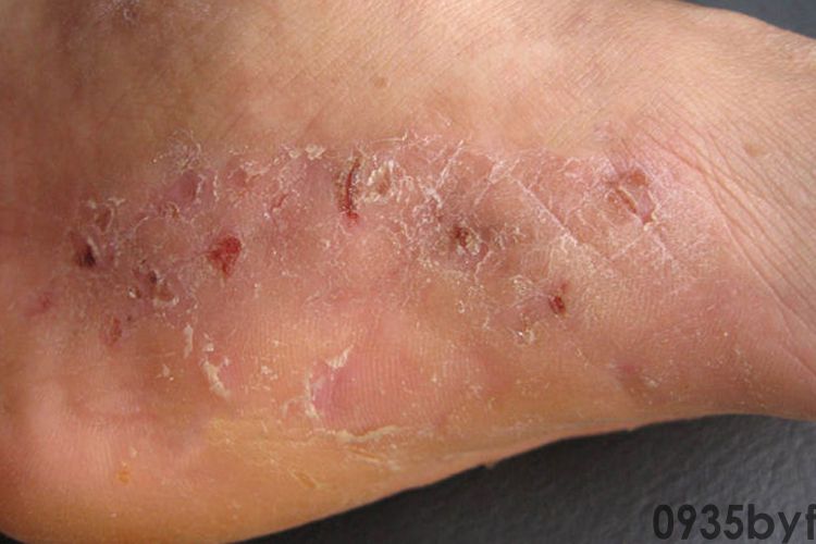 什么是脚气?(图1) 什么是脚气?