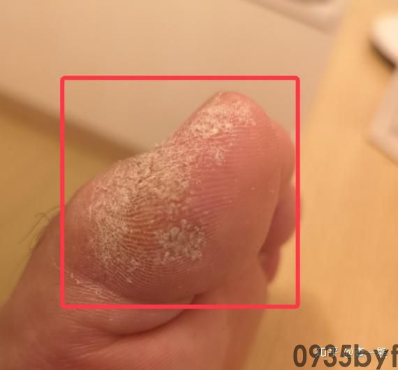 鳞屑皮肤病是怎么引起的(图1) 鳞屑皮肤病是怎么引起的