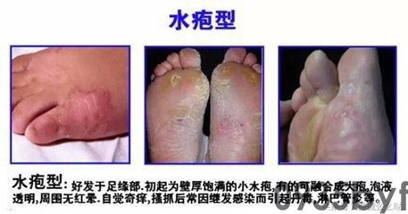 水泡型脚气怎么才能治愈-有来医生