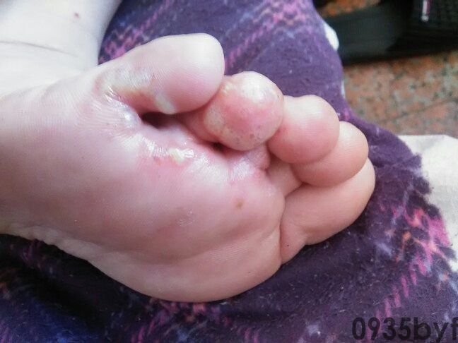 浸渍糜烂型足癣的病因及治疗是什么(图1) 浸渍糜烂型足癣的病因及治疗是什么