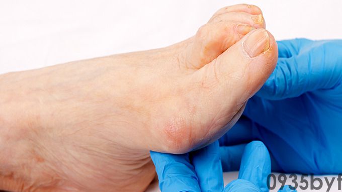 水泡型脚气怎么治(图1)