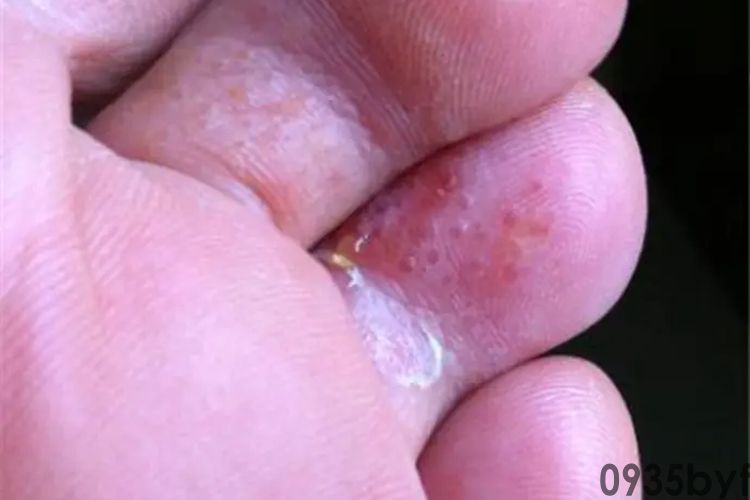 为什么会得水泡型脚气