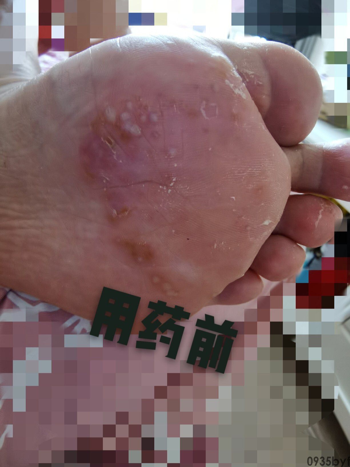 水泡型脚气的原因