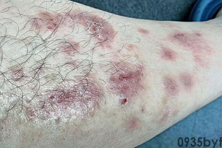 腿上一块一块红斑图片(图2)