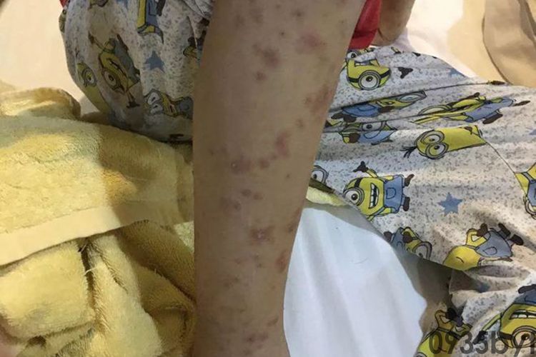 腿上一块一块红斑图片(图3)