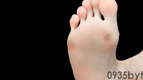 水泡型脚气的症状是什么(图1)