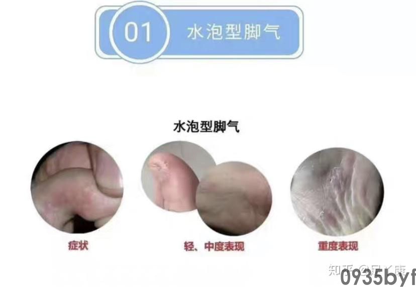 脚气水泡可以弄破吗