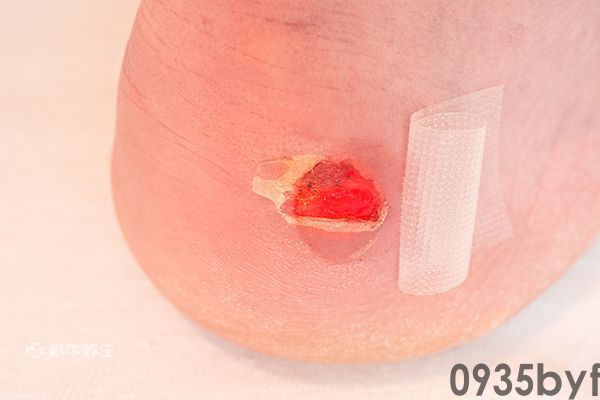 脚上长水泡图片 脚上长水泡是什么原因引起的(图2)