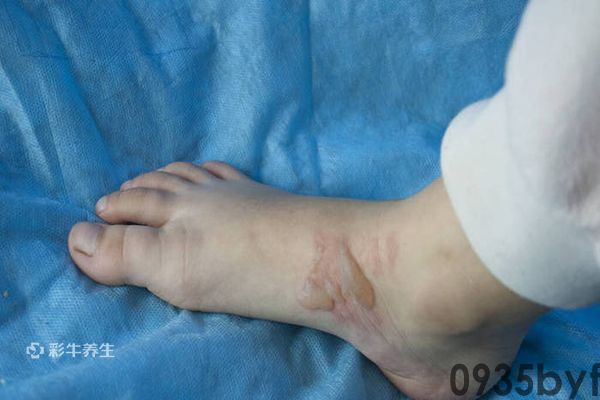 脚上长水泡图片 脚上长水泡是什么原因引起的(图1)