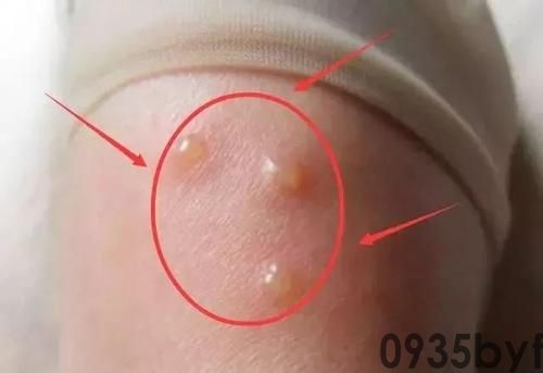 新鲜！现在脚气也能长手上了？(图2)