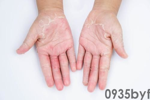 新鲜！现在脚气也能长手上了？(图3)