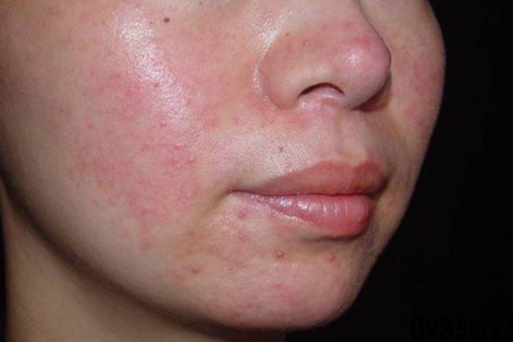 面部红斑皮炎图片(图2) 面部红斑皮炎图片(图2)