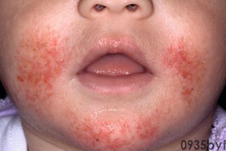 面部红斑皮炎图片(图3) 面部红斑皮炎图片(图3)