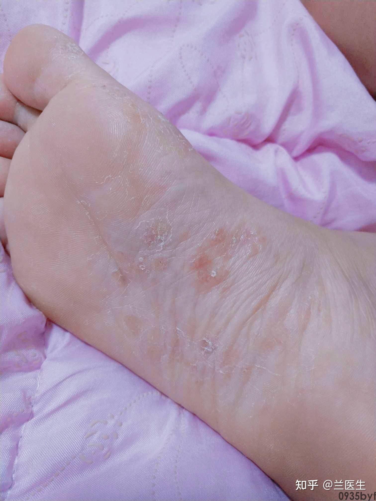 夏天脚长小水泡很痒怎么治(图1) 夏天脚长小水泡很痒怎么治