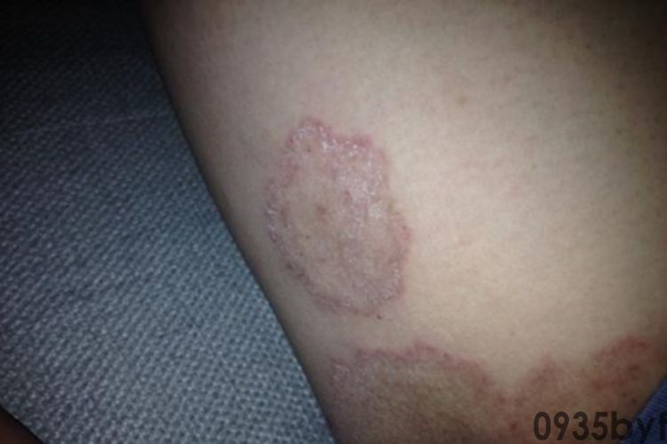 红癣红斑图片_有来医生(图2) 红癣红斑图片_有来医生(图2)