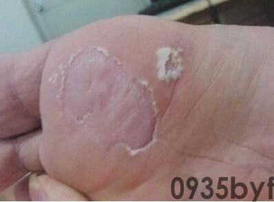 脚气的治疗看完你的脚气病也能治好！(图2)