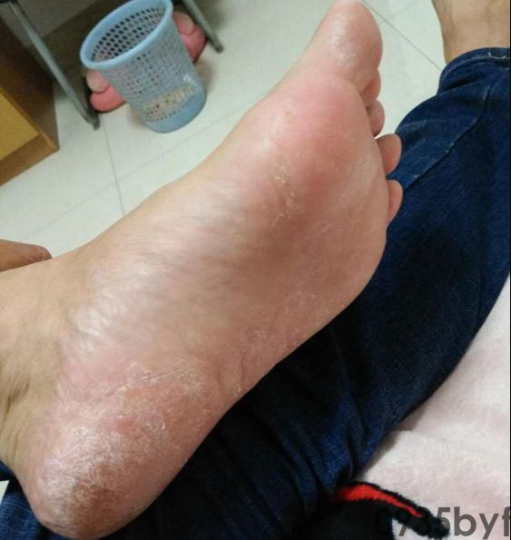 脚气的治疗看完你的脚气病也能治好！(图4)