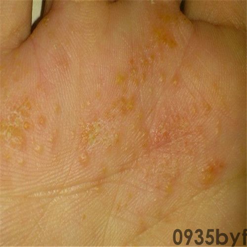 脚气的治疗看完你的脚气病也能治好！(图3)