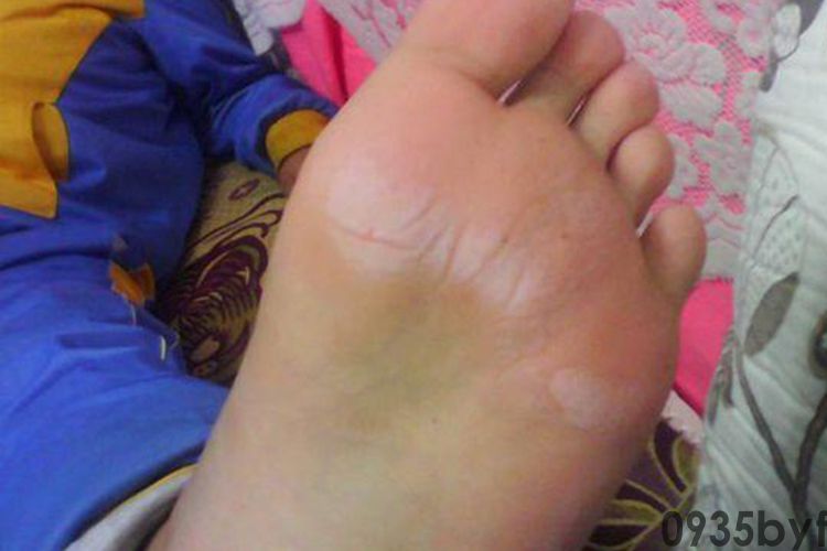 脚气初期图片_有来医生(图3)