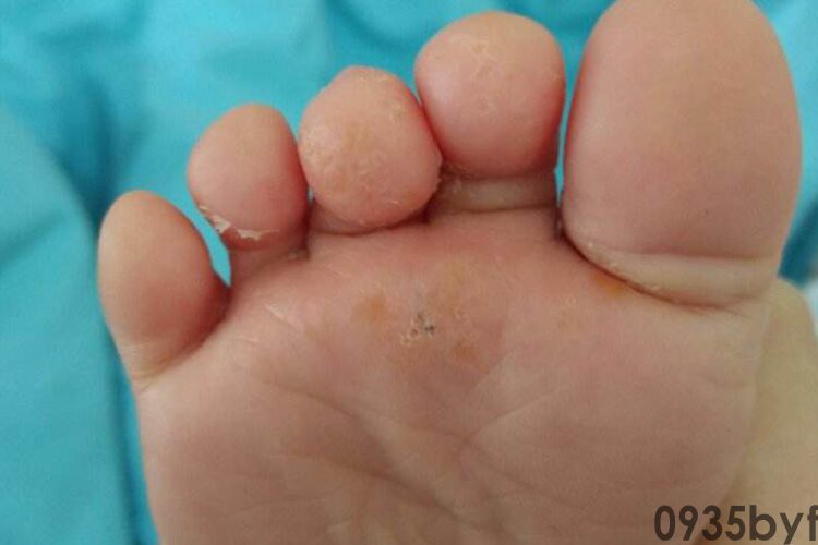 脚气初期图片_有来医生(图2)