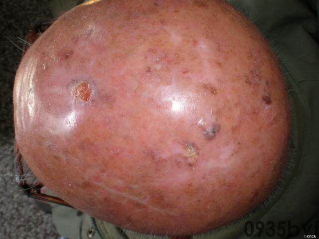 常见皮肤疾病典型图片汇总(图7)