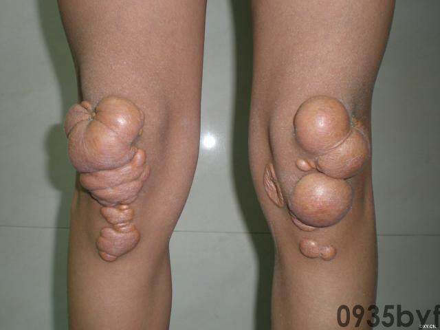 常见皮肤疾病典型图片汇总(图2)