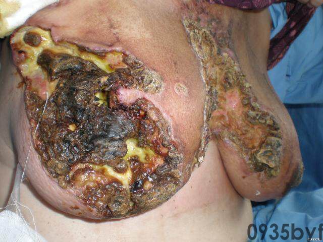 常见皮肤疾病典型图片汇总(图10)