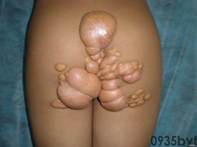 常见皮肤疾病典型图片汇总(图3)