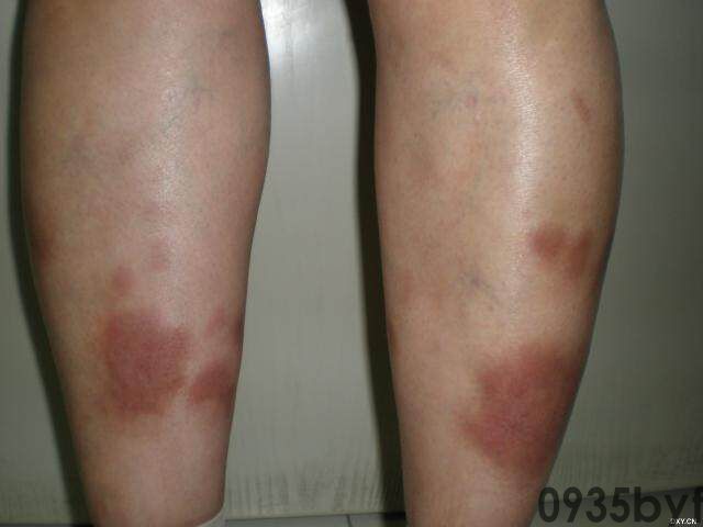 常见皮肤疾病典型图片汇总(图6)