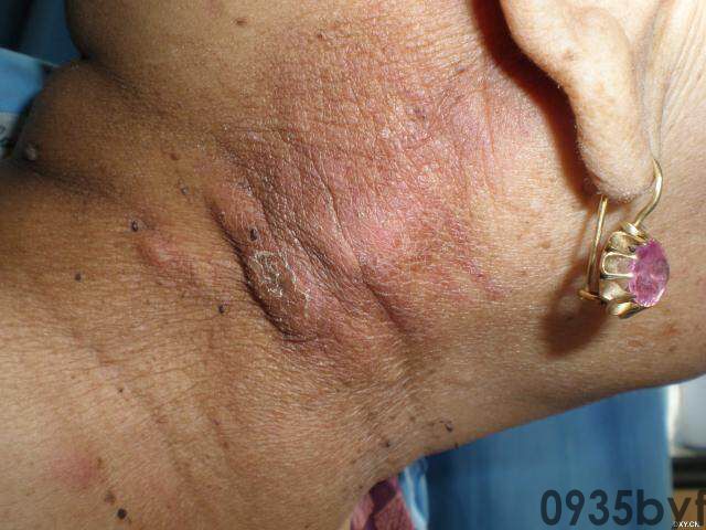 常见皮肤疾病典型图片汇总(图9)